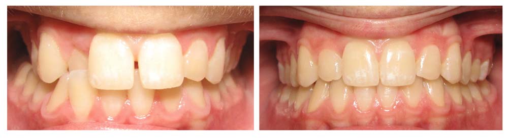 Before & After of Invisalign Patient Smile