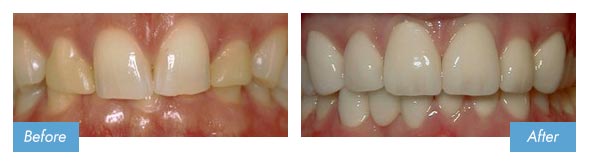 Before & After Porcelain Veneers Randolph Patient