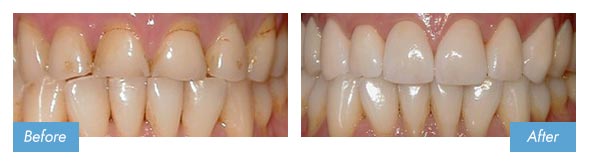 Veneers Patient Before & After Photo