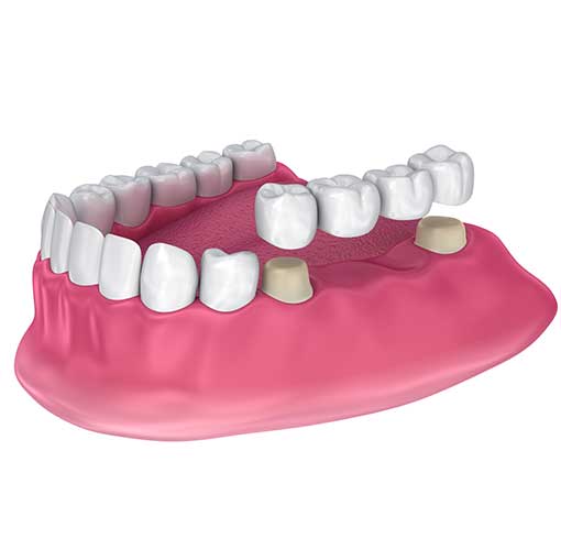 Implant Dental Bridge