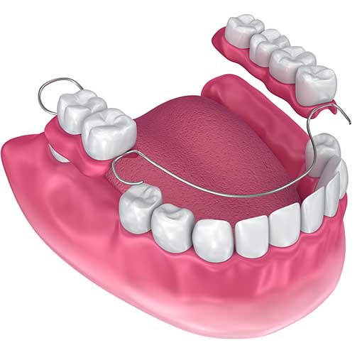 Removable Dental Bridge