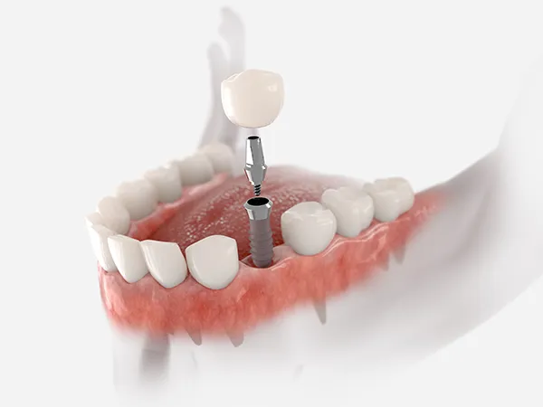 Dental Implant Illustration