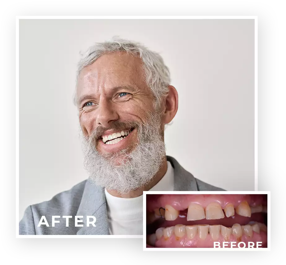 Dental Implants Patient Before & After Denture