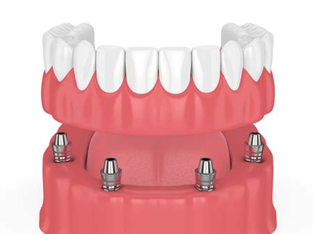 Full Mouth Dental Implants All-on-4 Illustration