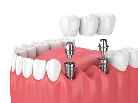 Implant Bridge Illustration