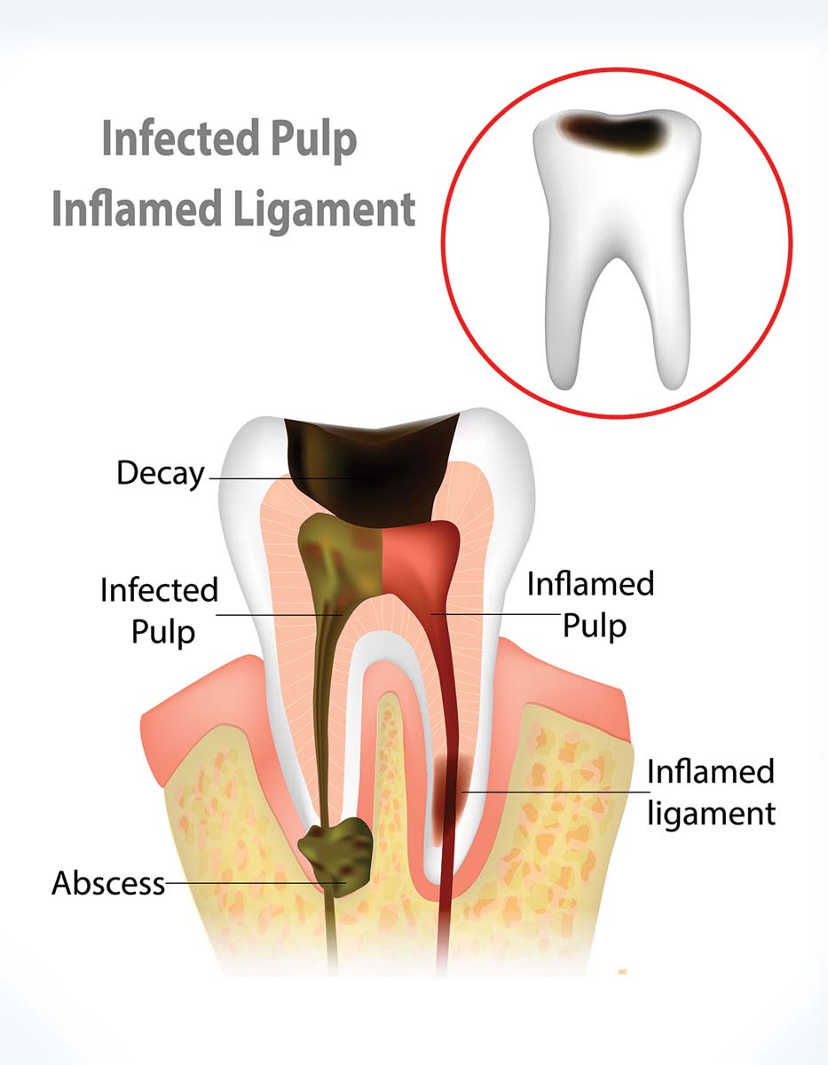 Infected Tooth & The Need for Root Canal Therapy