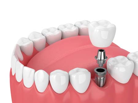 Single Dental Implant Illustration