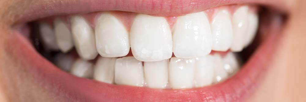Teeth Whitening Patient After Treatment