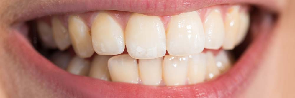 Teeth Whitening Patient Before Treatment