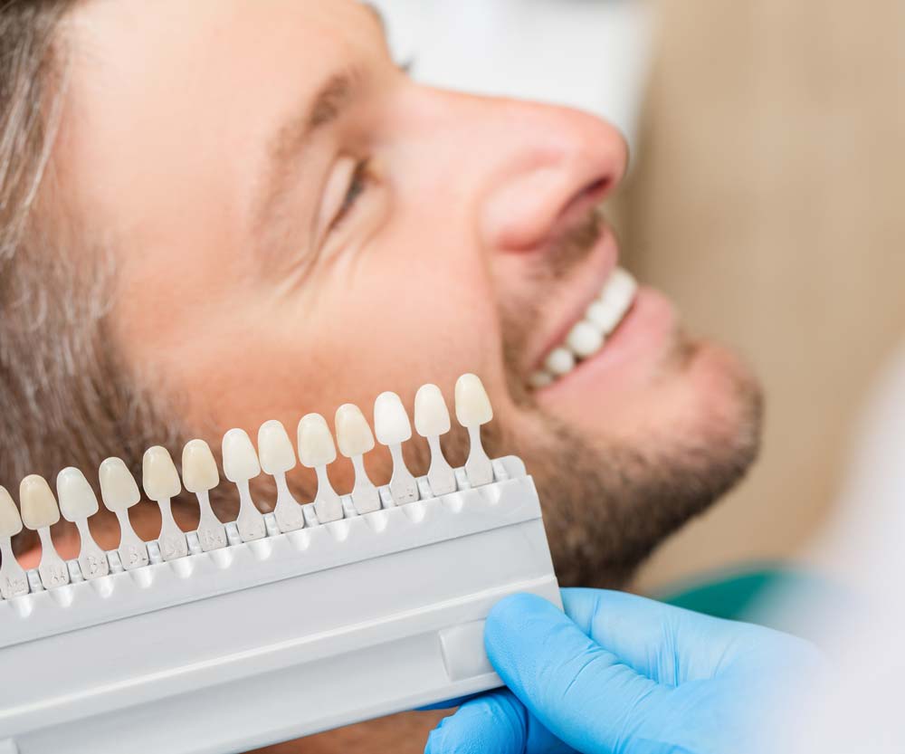 Tooth Shade Guide for Dental Bonding